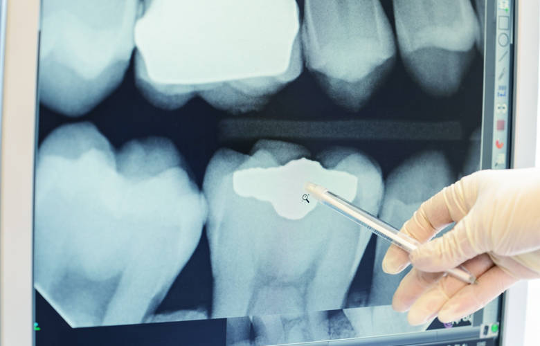 οδοντιατρική ακτινογραφία
