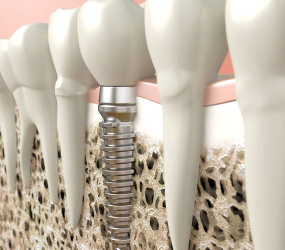 Οδοντικά εμφυτεύματα: Κατασκευή και οστεοεσωμάτωση