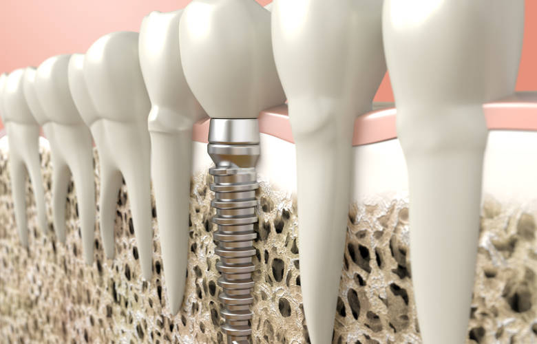 Οδοντικά εμφυτεύματα: Κατασκευή και οστεοεσωμάτωση