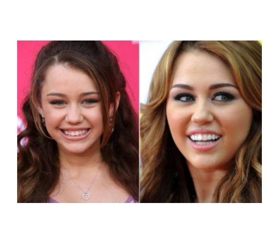 Διάσημοι πριν...και μετά τον οδοντίατρο!