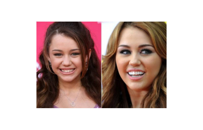 Διάσημοι πριν...και μετά τον οδοντίατρο!