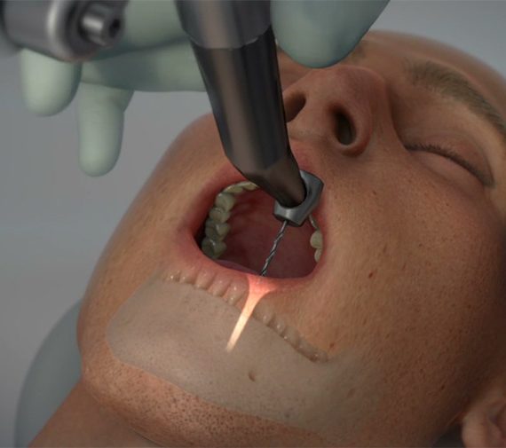Ρομποτικό σύστημα καθοδήγησης αλλάζει την εμφυτευματική οδοντιατρική!