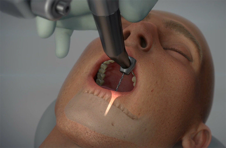Ρομποτικό σύστημα καθοδήγησης αλλάζει την εμφυτευματική οδοντιατρική!