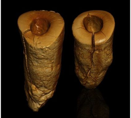 Πρώιμα σφραγίσματα βρέθηκαν σε σκελετό 13.000 ετών!