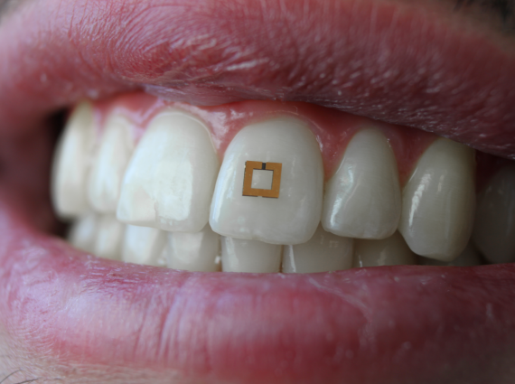Επιστήμονες αναπτύσσουν μικροσκοπικούς αισθητήρες για τα δόντια που εντοπίζουν ό,τι τρώμε!