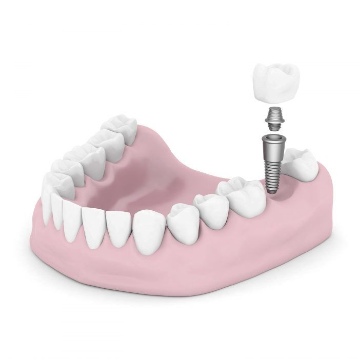 Βιο-μηχανικοί βλαστοί δοντιού αντικαθιστούν τα οδοντικά εμφυτεύματα;