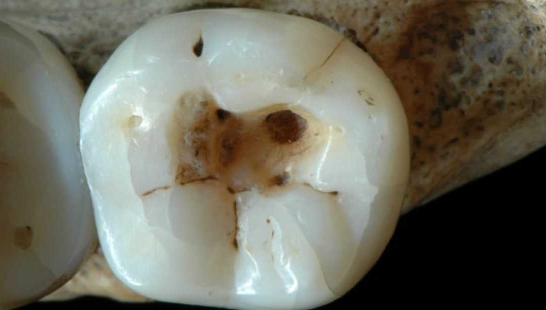 14,000 ετών δόντι αποκαλύπτει τις οδοντιατρικές τεχνικές της Παλαιολιθικής Εποχής!