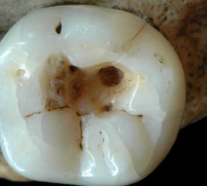 14,000 ετών δόντι αποκαλύπτει τις οδοντιατρικές τεχνικές της Παλαιολιθικής Εποχής!