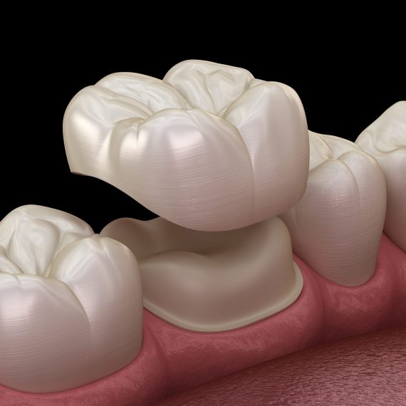 Ερωτήσεις και απαντήσεις για τις οδοντικές θήκες